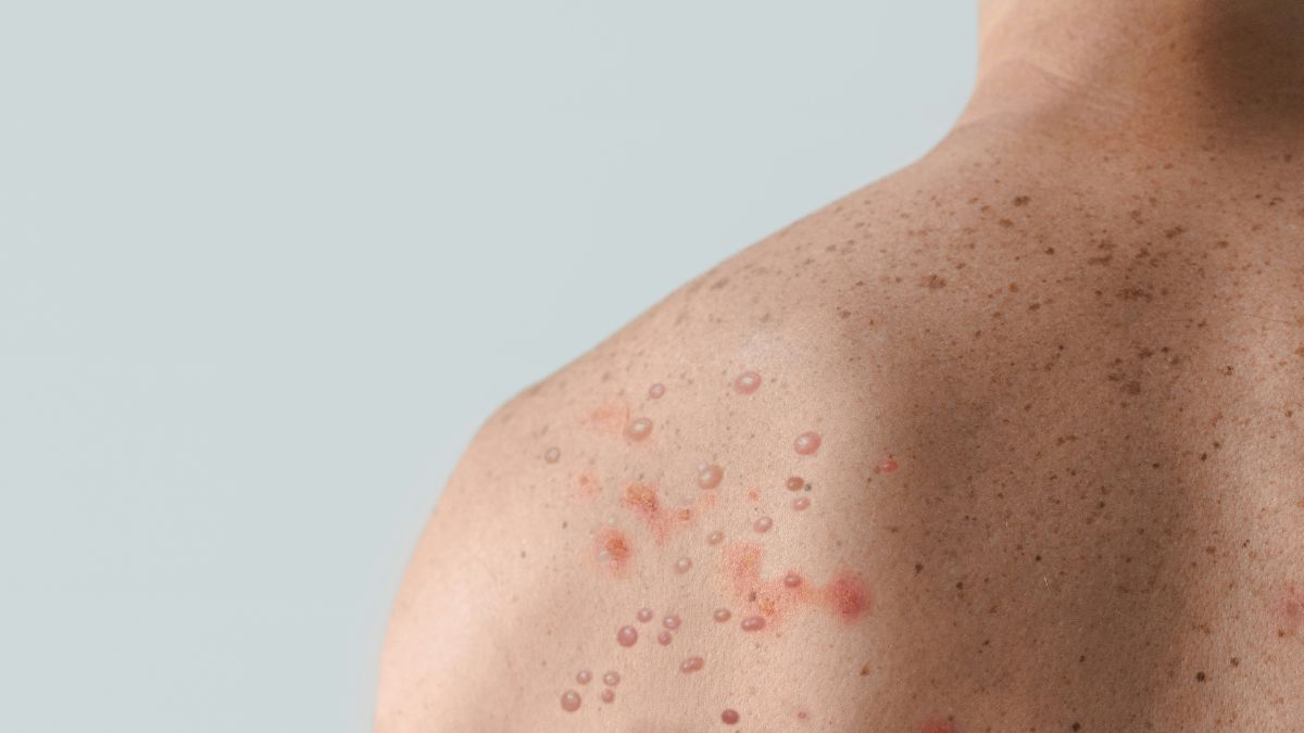 Understanding coverage, eligibility, and what you need to know about shingles vaccines