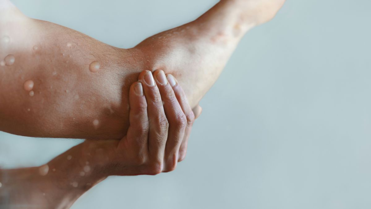 Do Medicaid or Medicare cover shingles shots? Coverage, eligibility and what to know about it depending on your plan 1 D2b 2